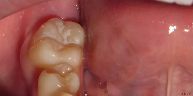 Fissurenversiegelung schützt Zähne vor Karies