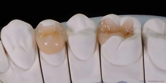 Alternativen zum Amalgam